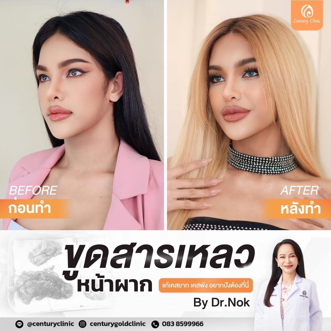Review เสริมหน้าผาก #31