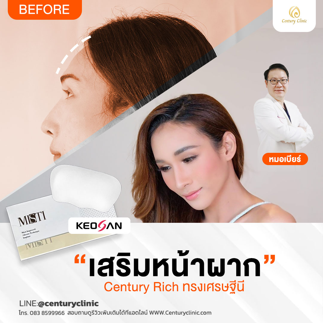 Review เสริมหน้าผาก #32