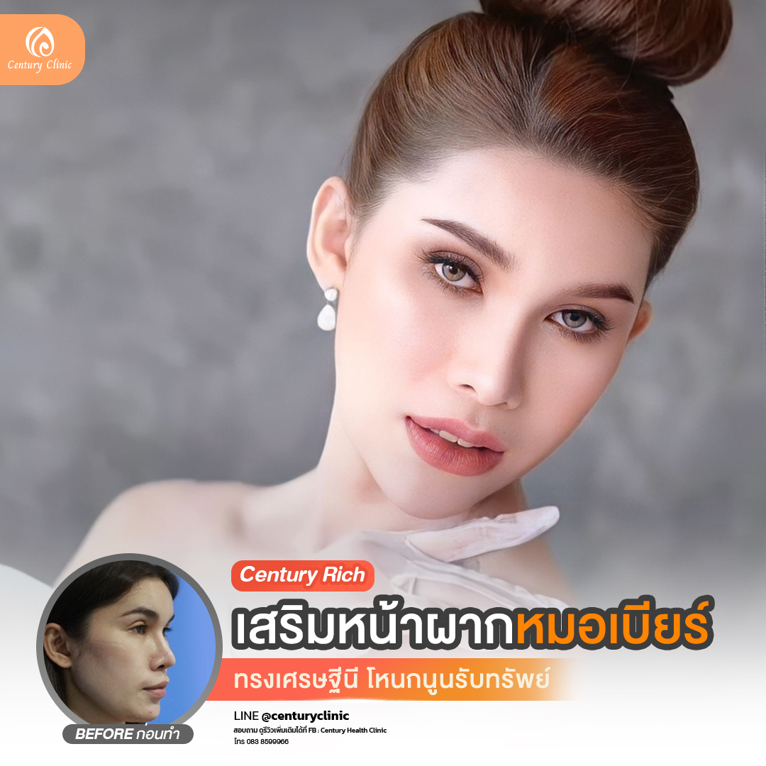 Review เสริมหน้าผาก #33