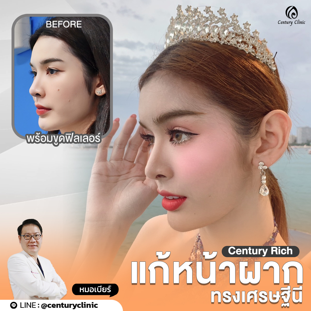 รีวิว เสริมหน้าผาก #34 , Century Clinic Thailand Review เสริมหน้าผาก #34