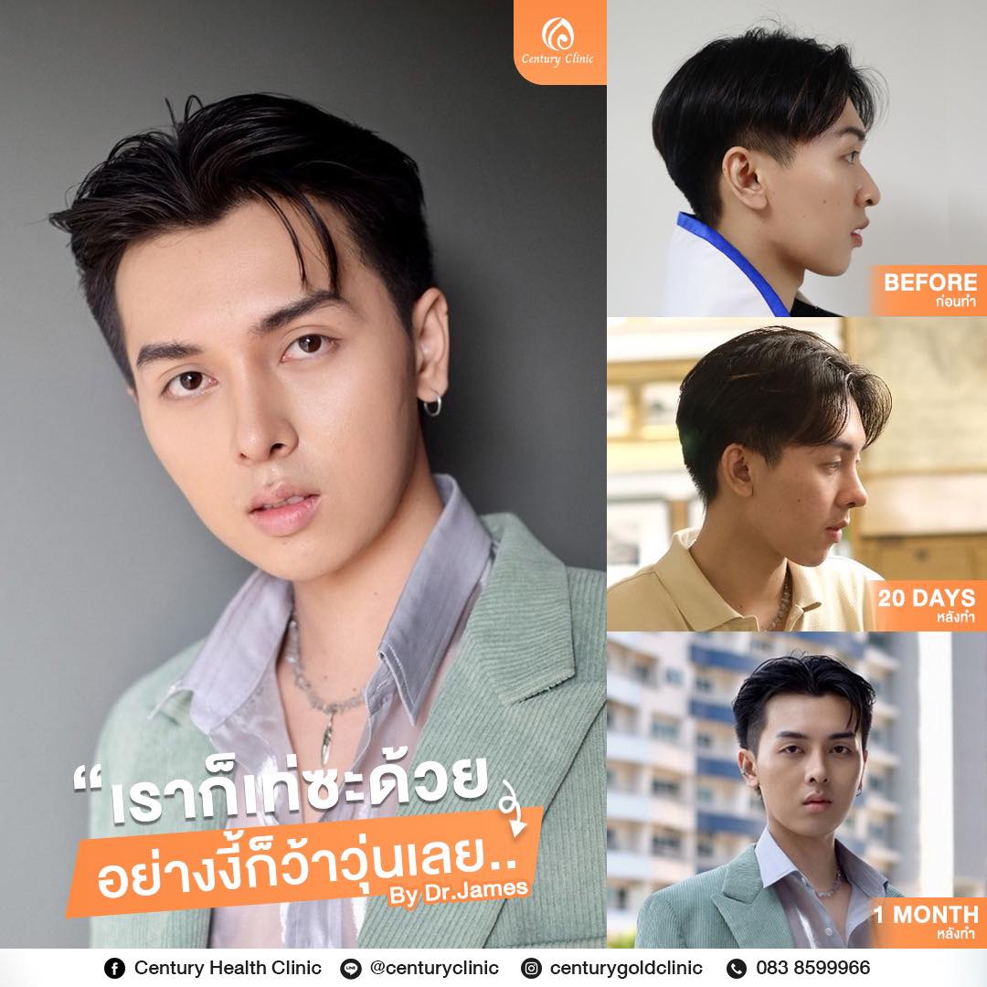 รีวิว เสริมจมูก#855