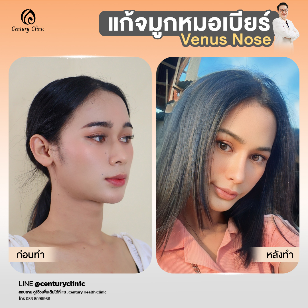 รีวิว แก้จมูก #837