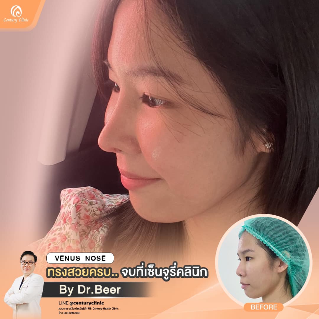 รีวิว แก้จมูก #846 , Century Clinic Thailand รีวิว แก้จมูก#846
