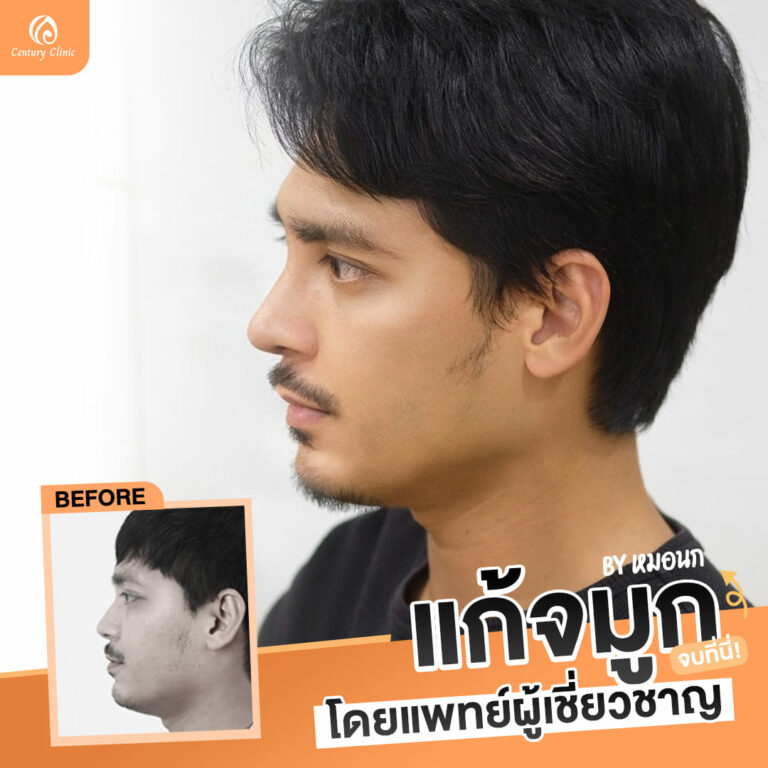 รีวิว แก้จมูก#860