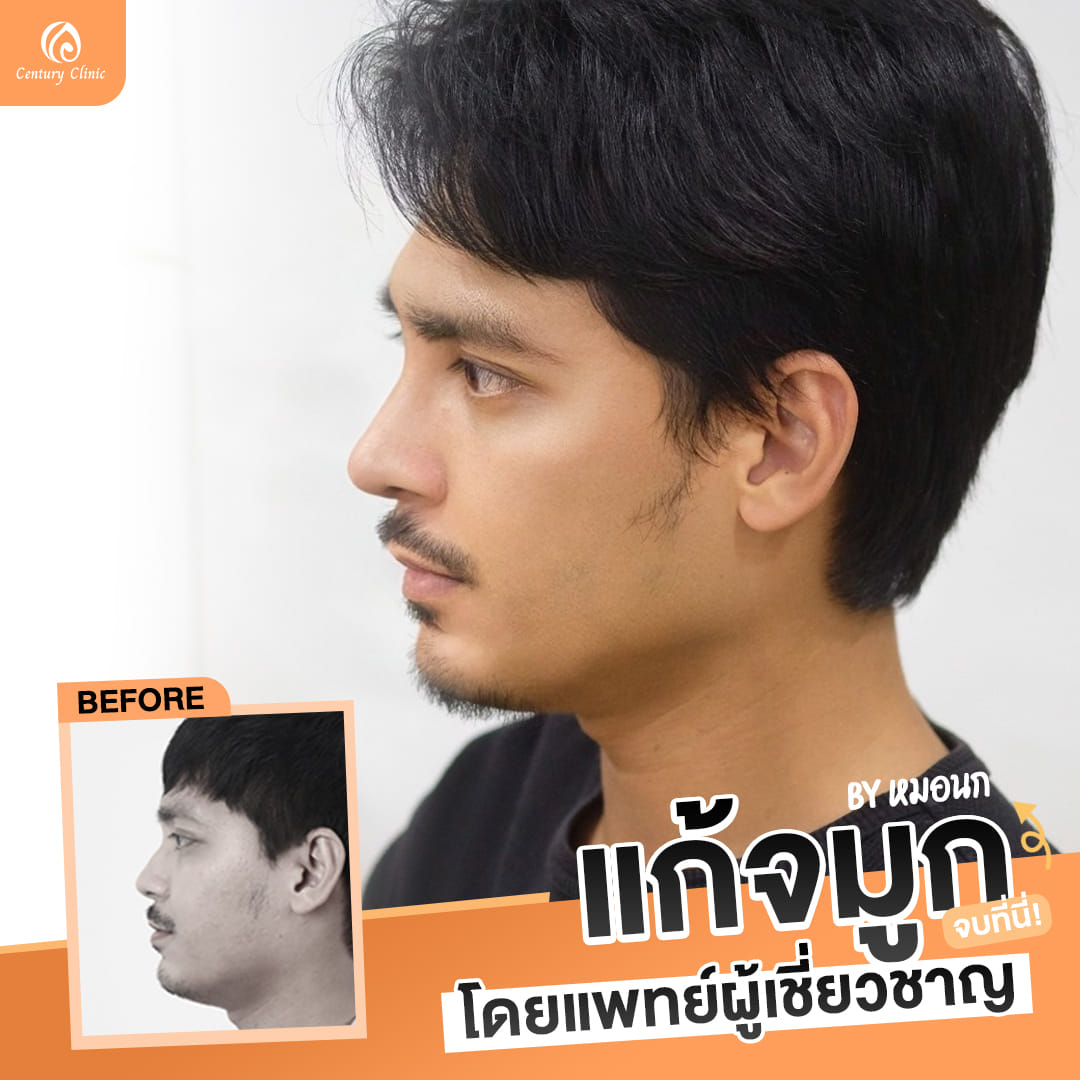รีวิว แก้จมูก #860 , Century Clinic Thailand รีวิว แก้จมูก#860
