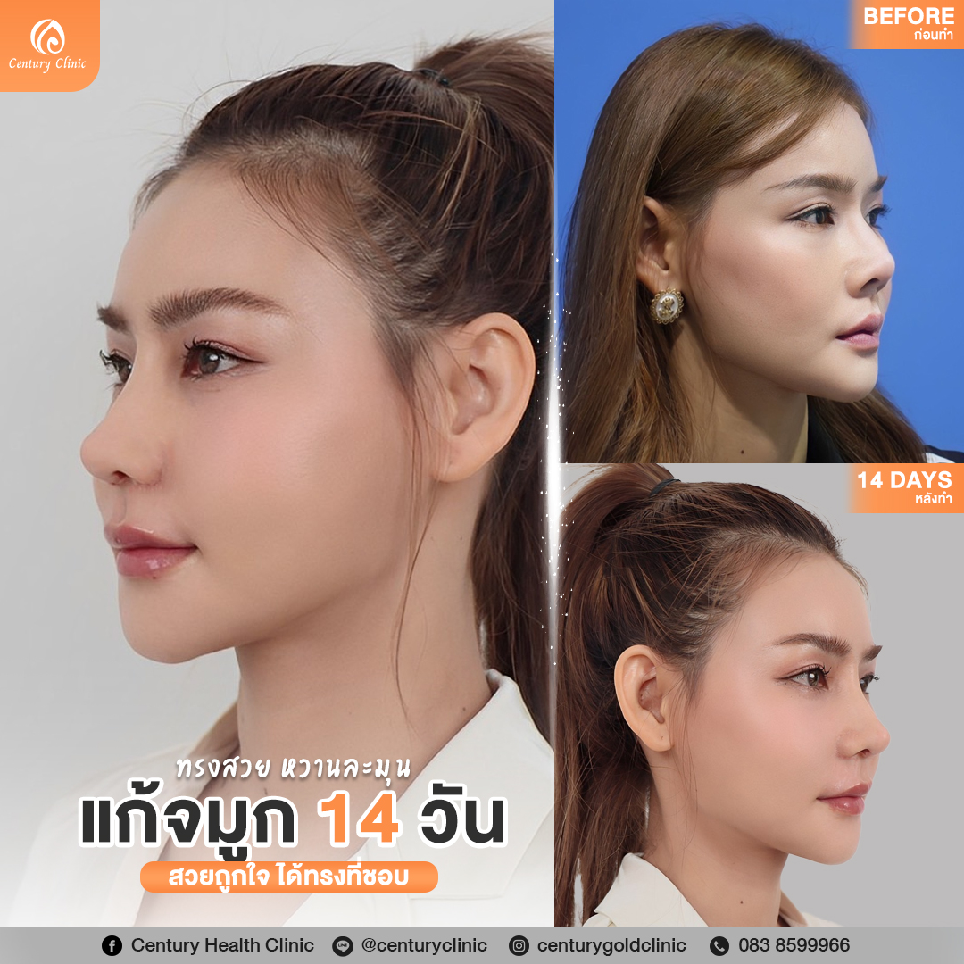 รีวิว แก้จมูก #844 , Century Clinic Thailand รีวิวแก้จมูก#844