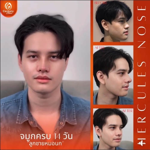 เสริมจมูก #923