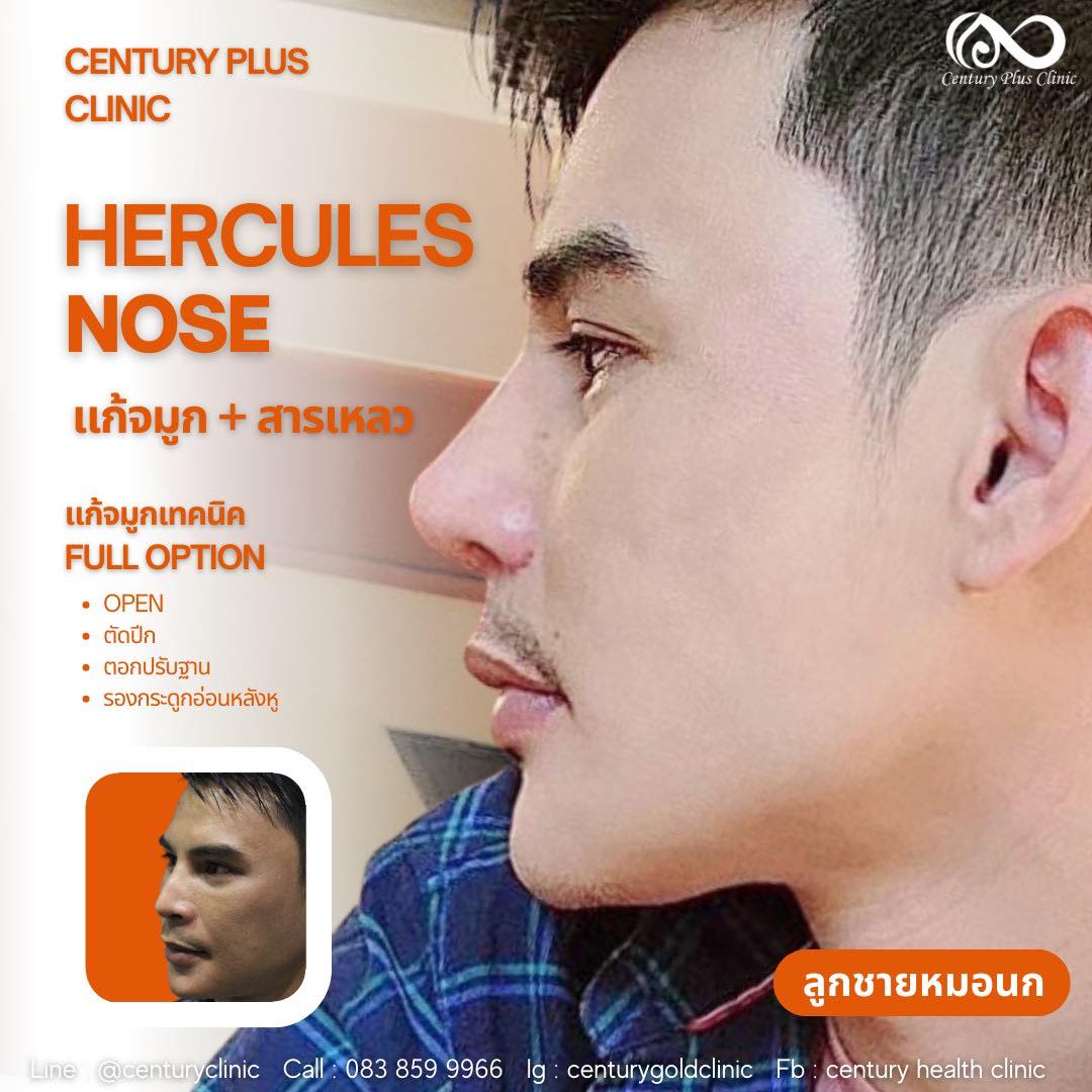 รีวิว แก้จมูก #914 , Century Clinic Thailand แก้จมูก #915