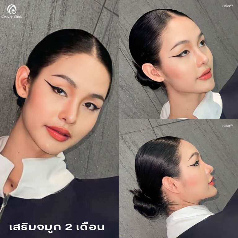 เสริมจมูก #952