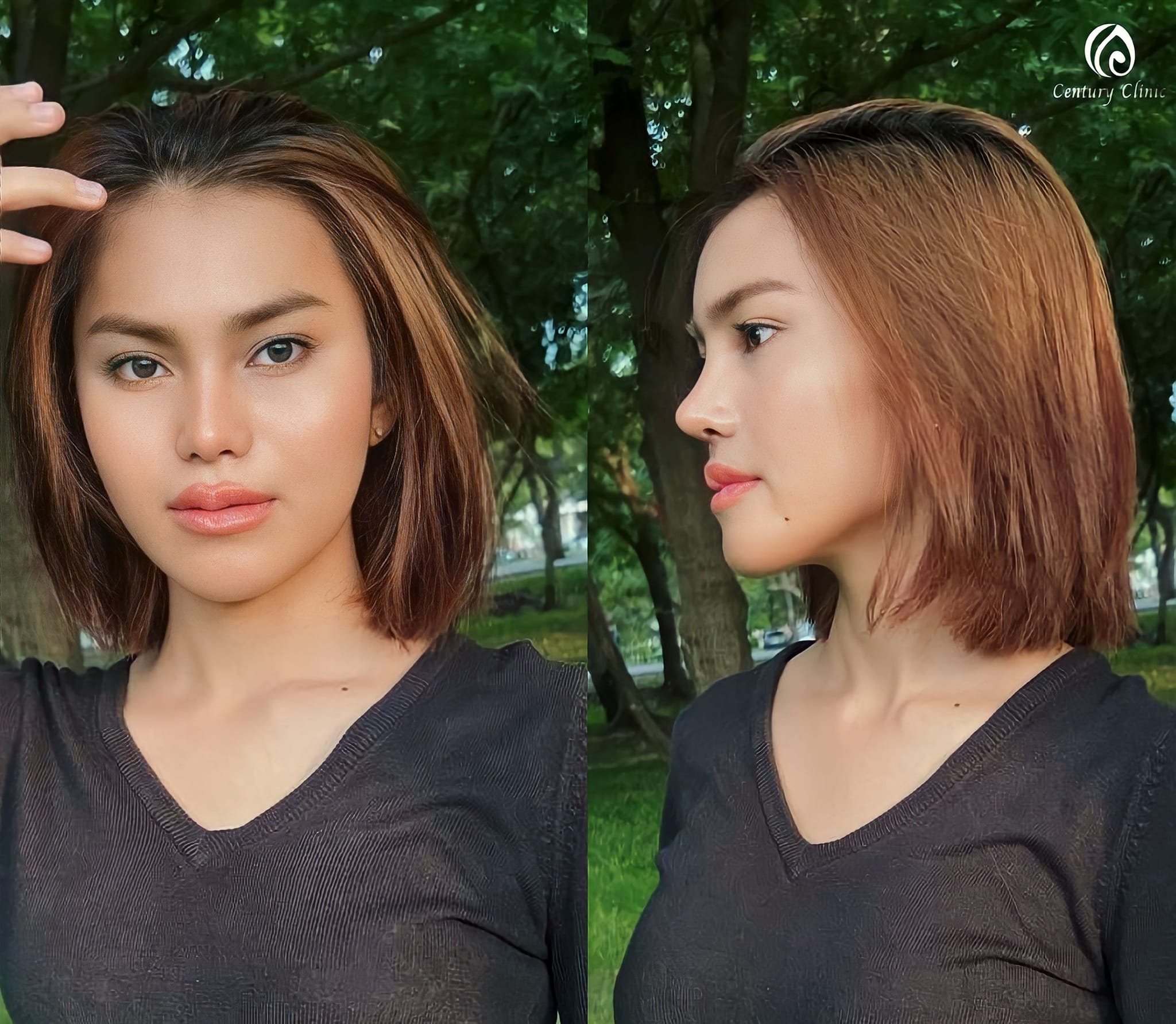 เสริมจมูก #955
