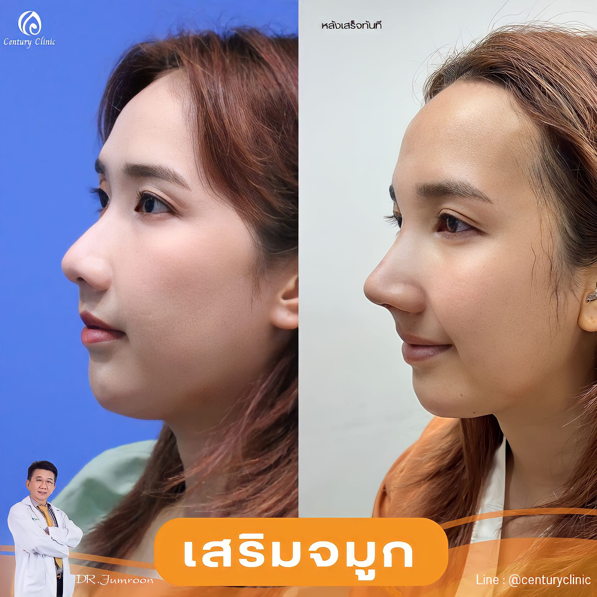 รีวิว เสริมจมูก #969 , Century Clinic Thailand เสริมจมูก #969