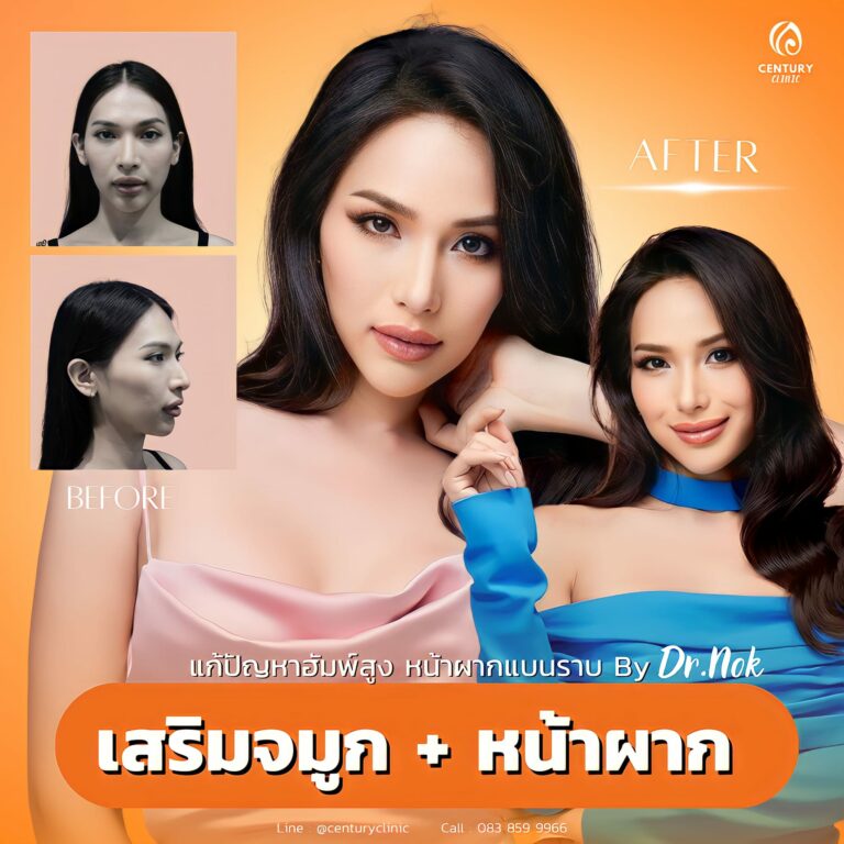 เสริมจมูก #974