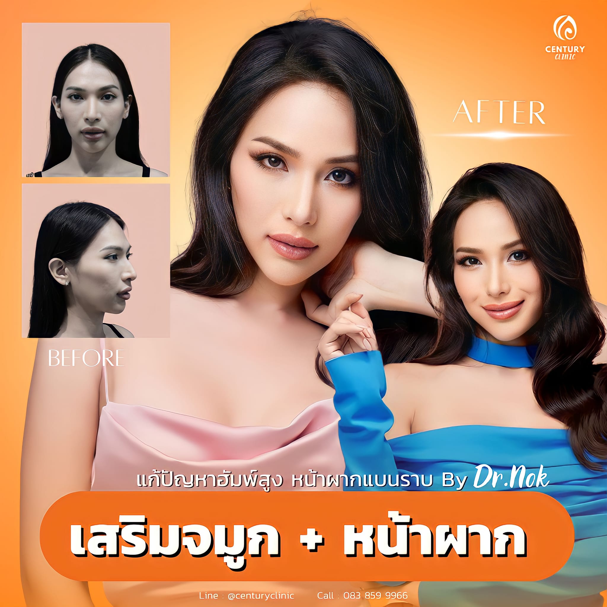 เสริมจมูก #974