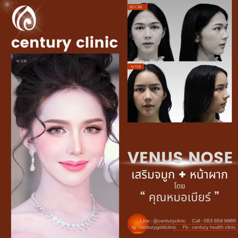 เสริมจมูก+หน้าผาก#927