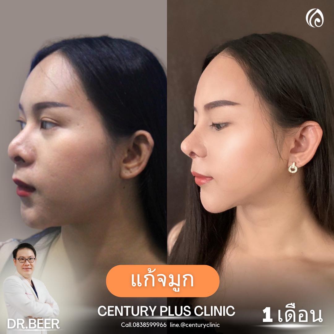 รีวิว แก้จมูก #932 , Century Clinic Thailand แก้จมูก #932