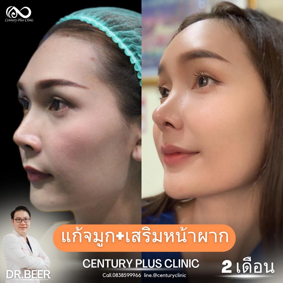 แก้จมูก #942