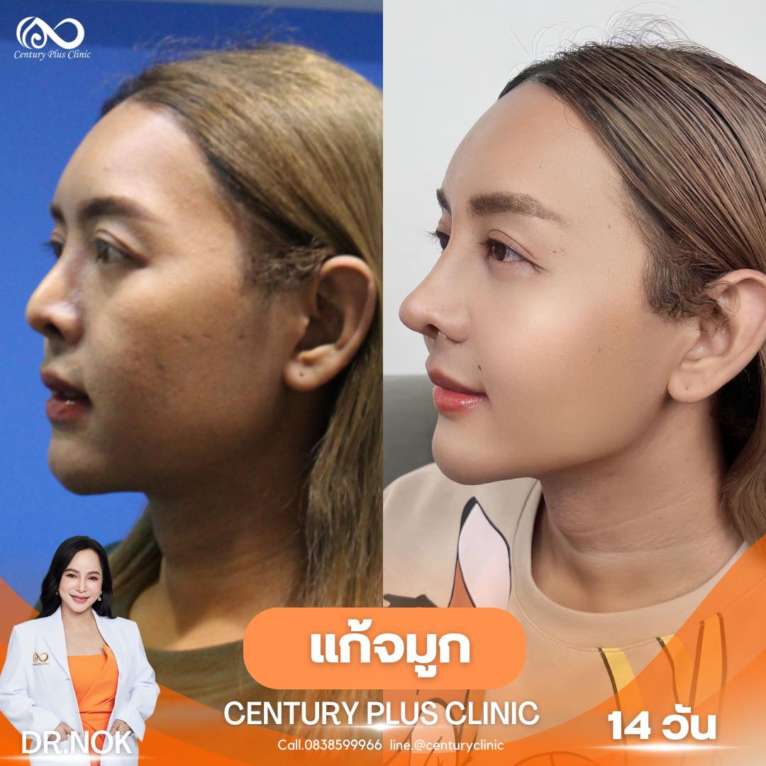 แก้จมูก #950