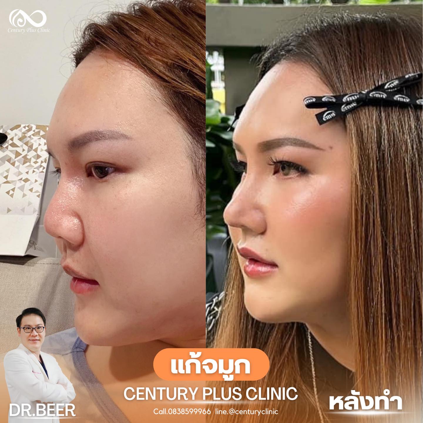 รีวิว แก้จมูก #956 , Century Clinic Thailand แก้จมูก #956