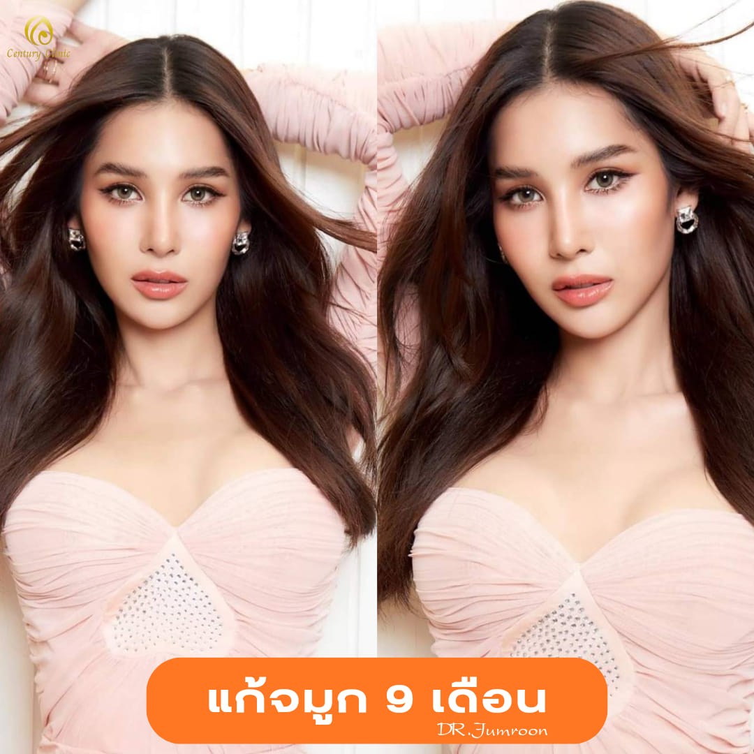 แก้จมูก #957