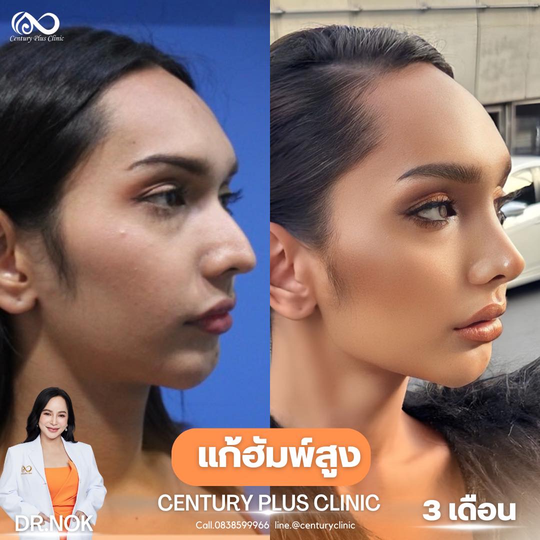 รีวิว แก้จมูก #958 , Century Clinic Thailand แก้จมูก #958