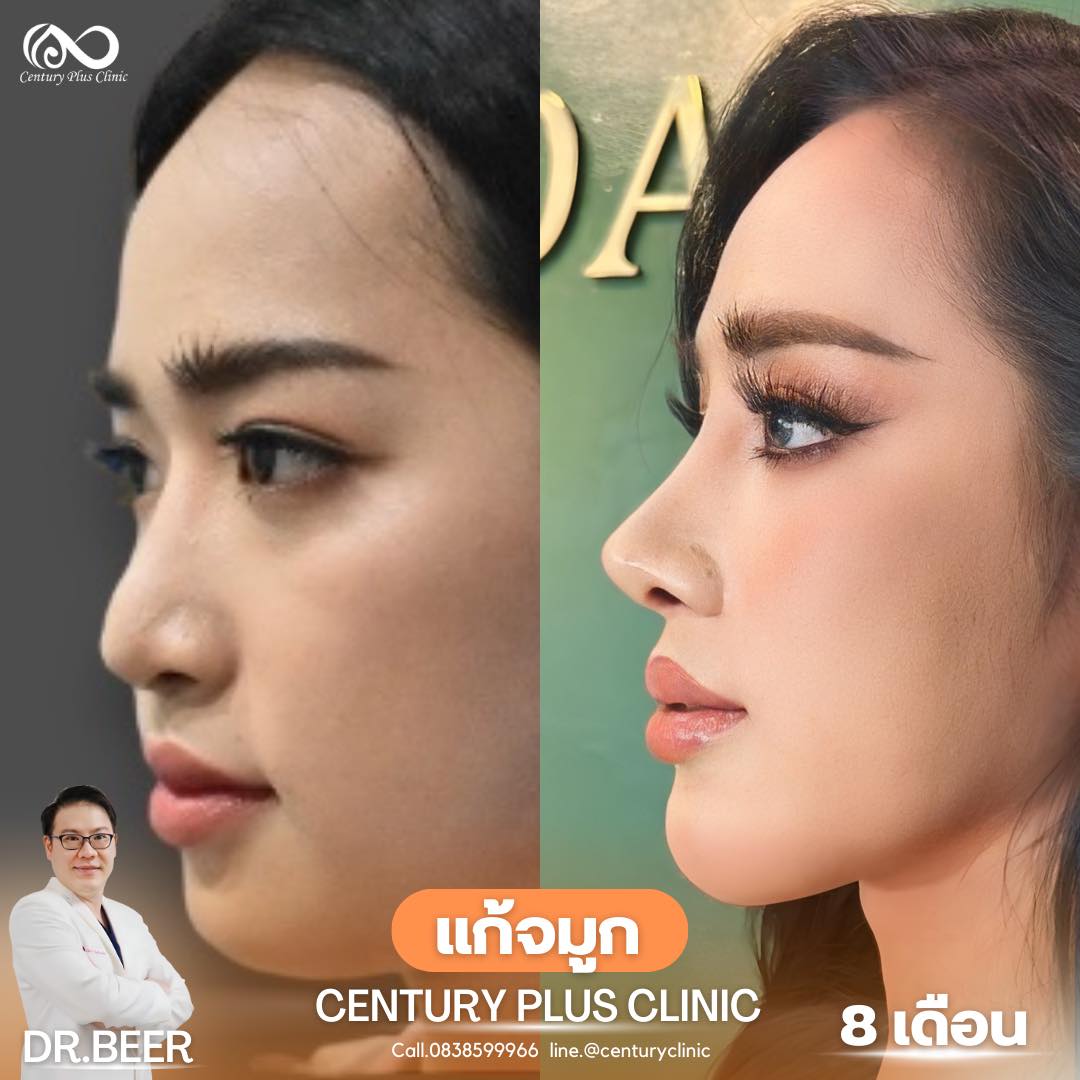แก้จมูก #966