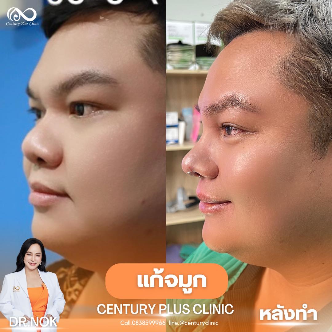 แก้จมูก #967