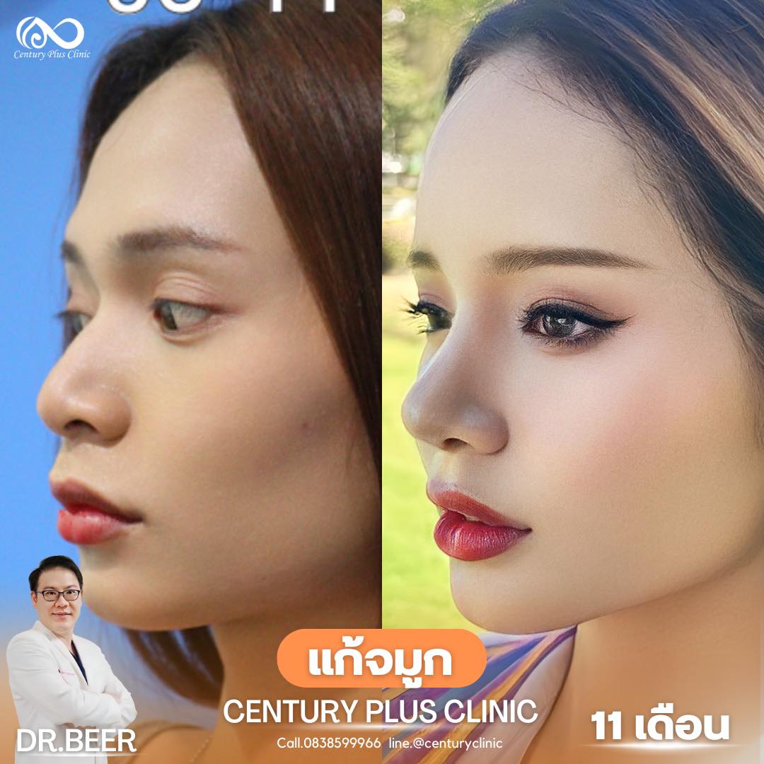 แก้จมูก #971
