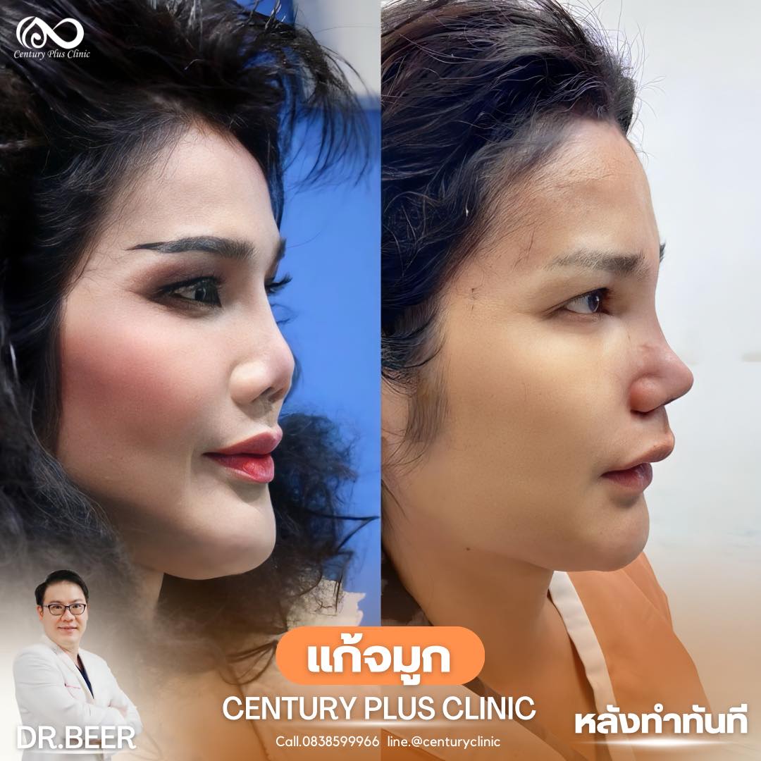 แก้จมูก #976