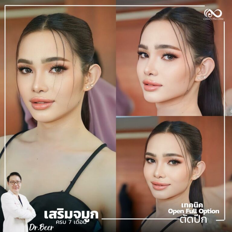 เสริมจมูก #1029