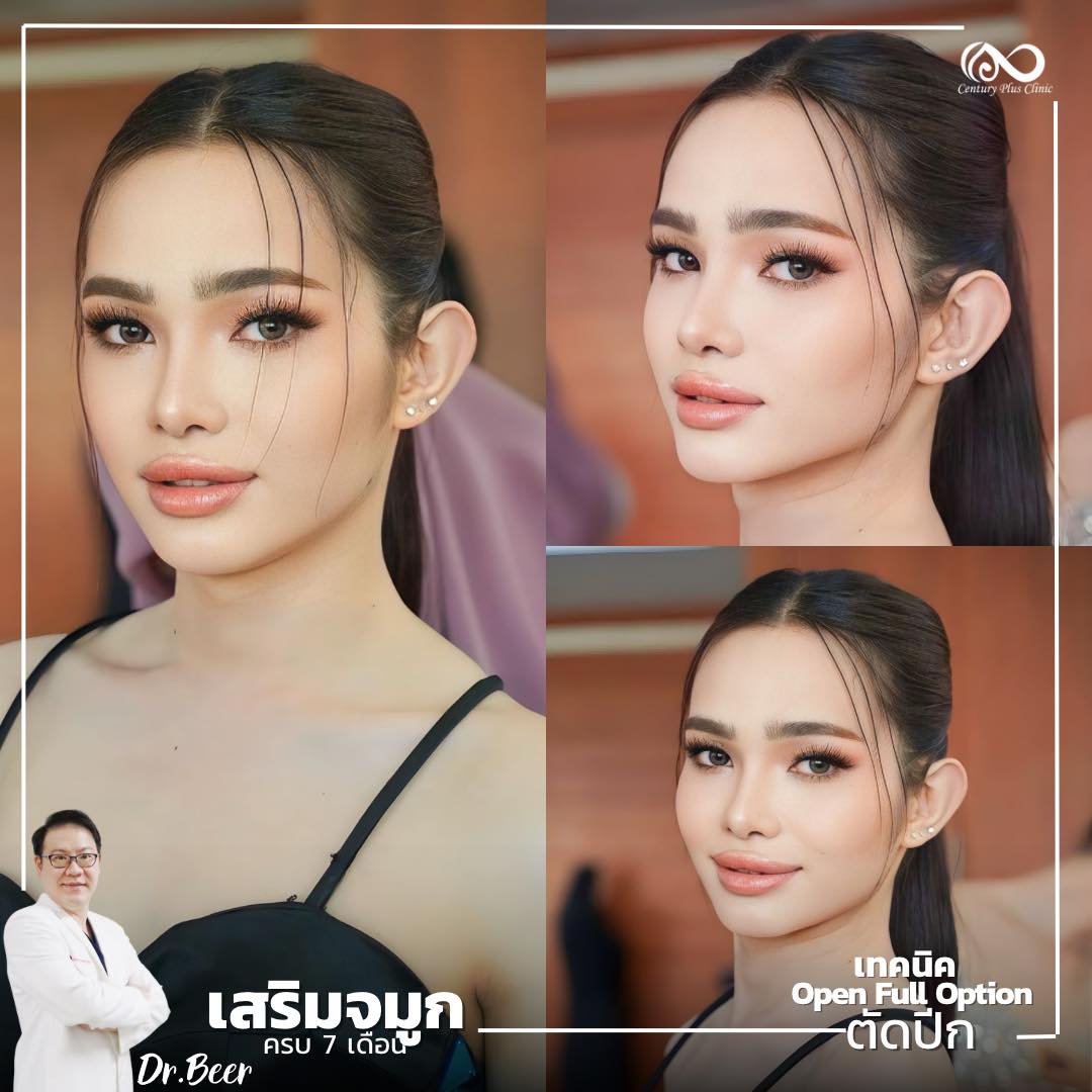 เสริมจมูก #1029
