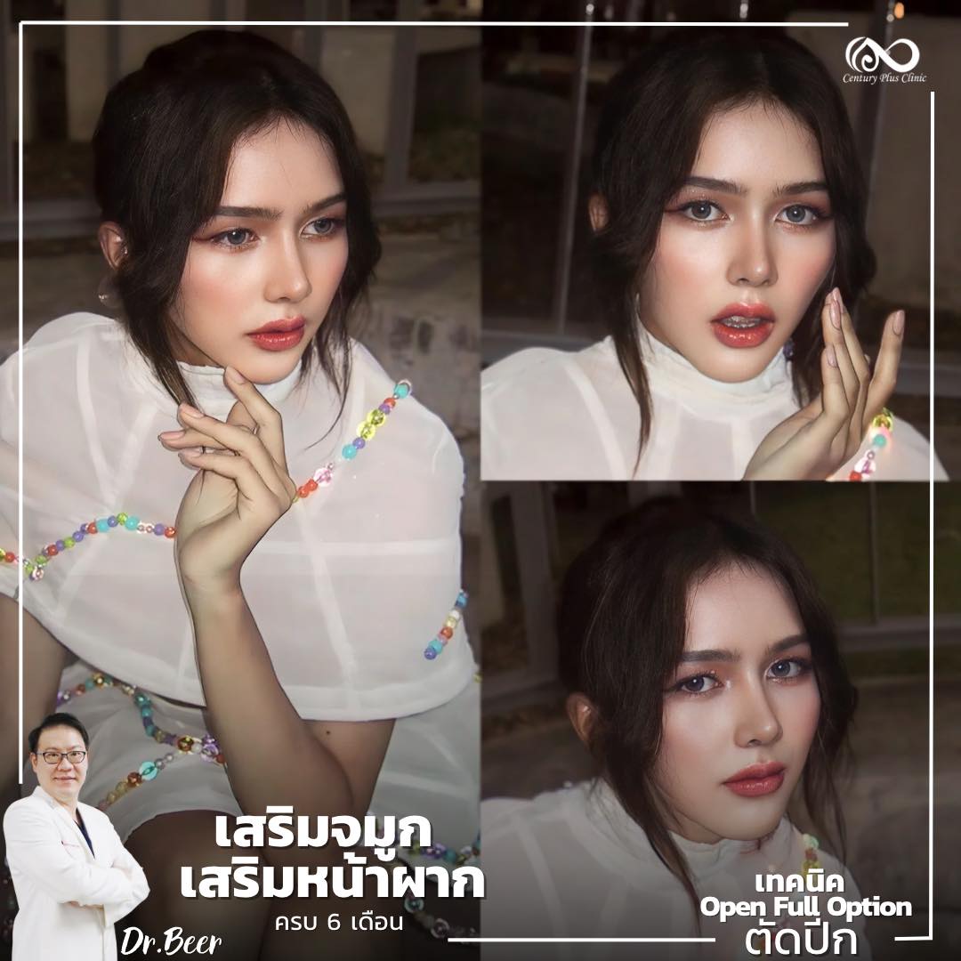 รีวิว เสริมจมูก #1047 , Century Clinic Thailand เสริมจมูก #1047