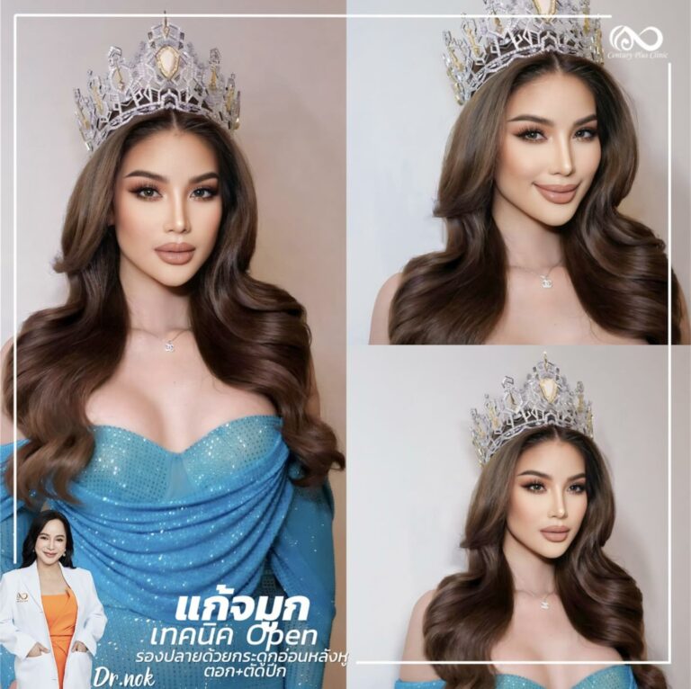 แก้จมูก #1005
