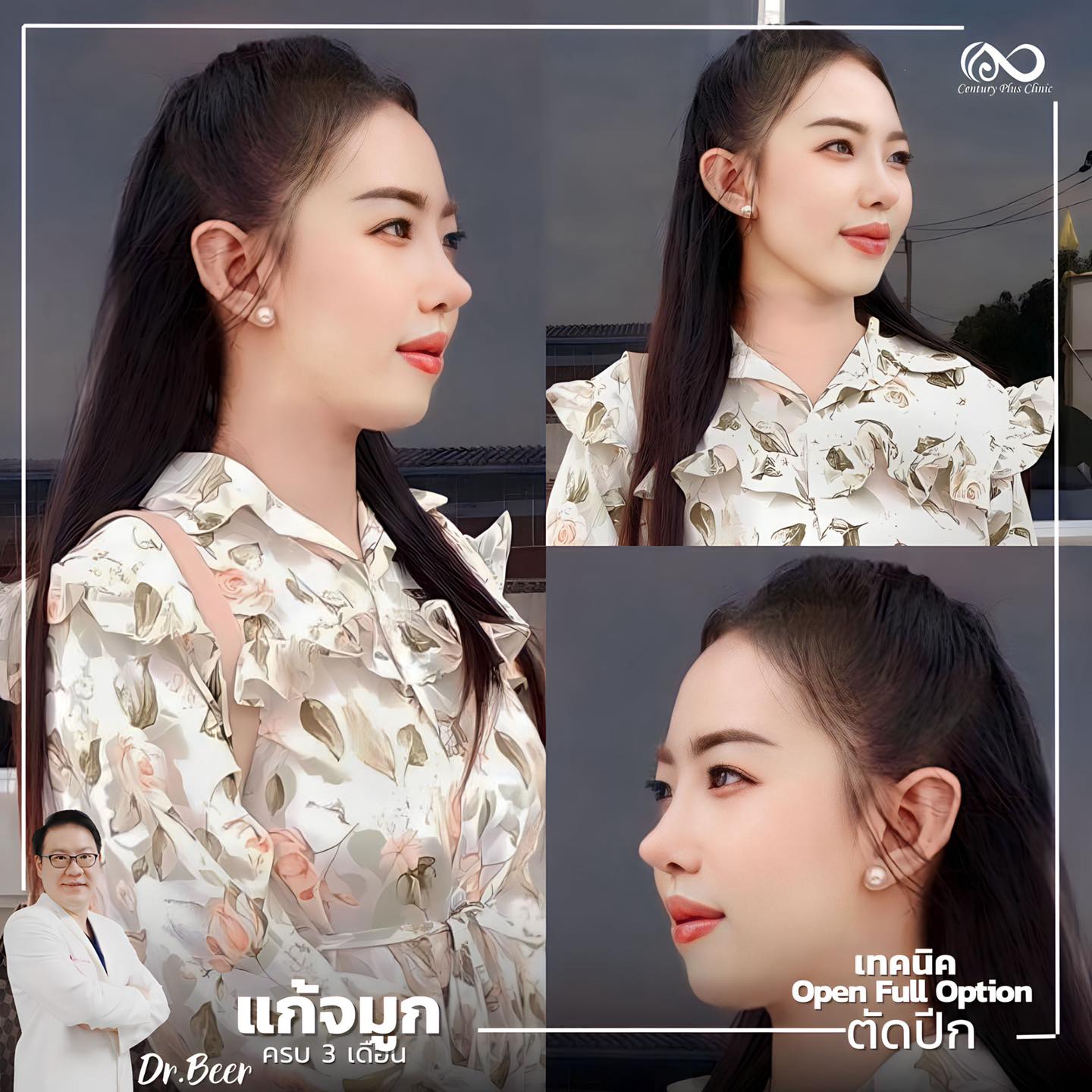 แก้จมูก #1012