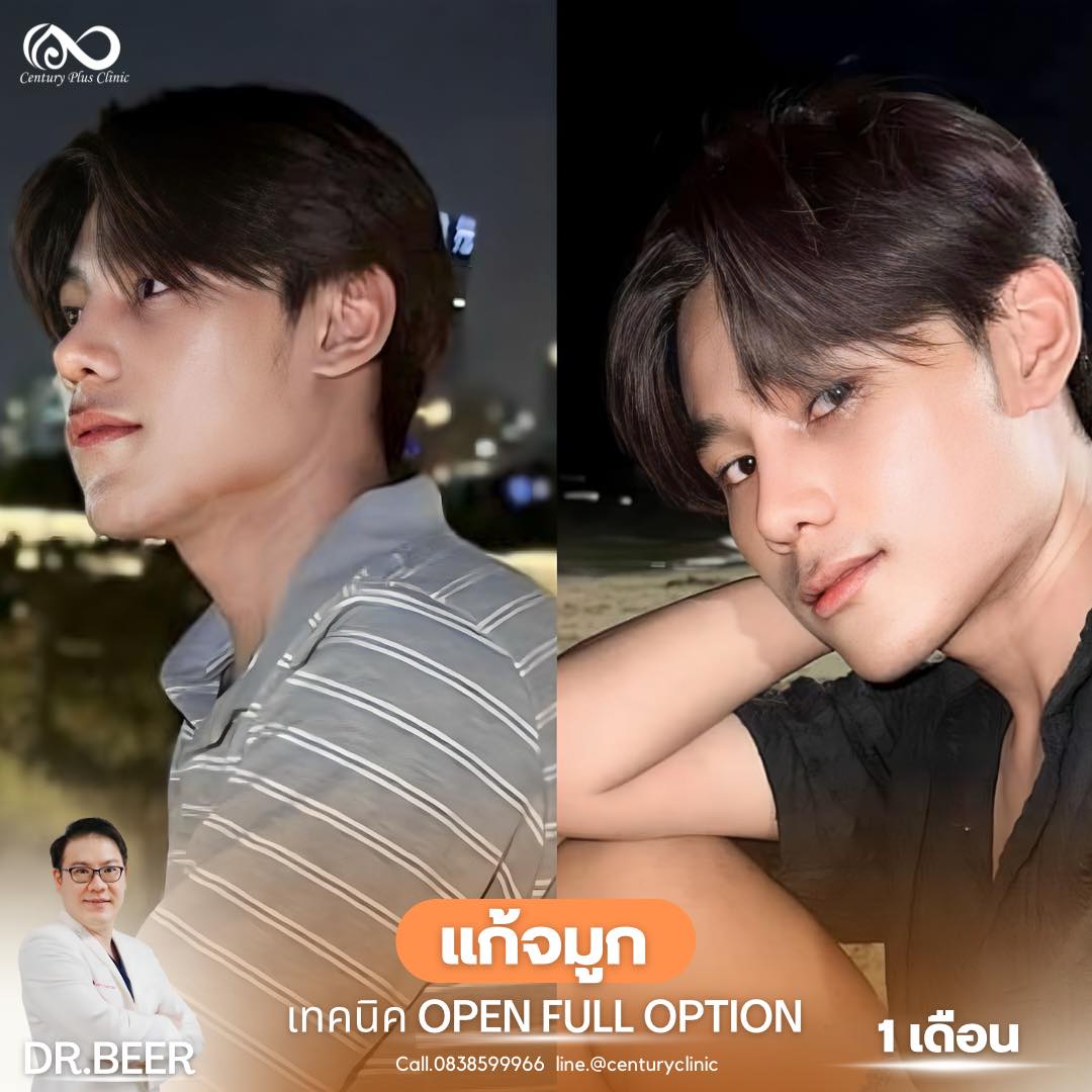 แก้จมูก #1020