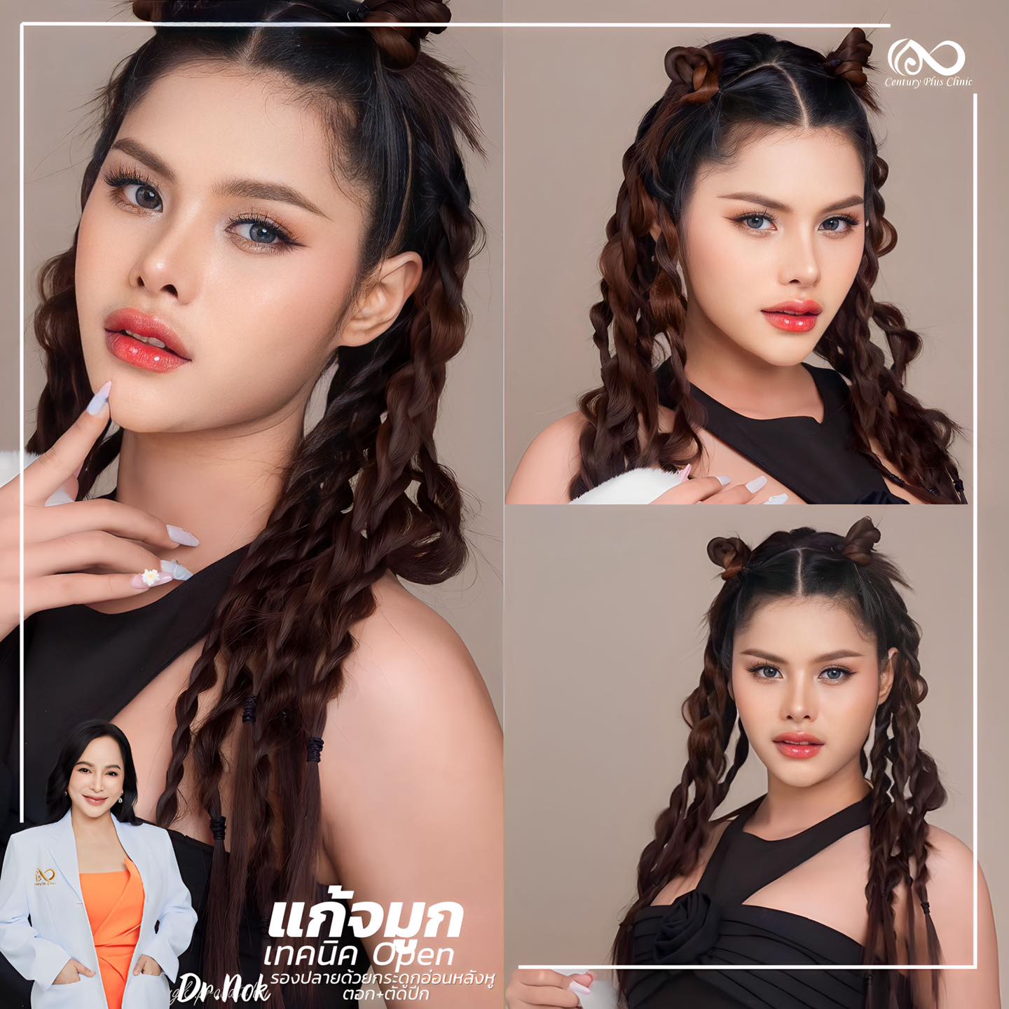 รีวิว แก้จมูก #1030 , Century Clinic Thailand แก้จมูก #1030