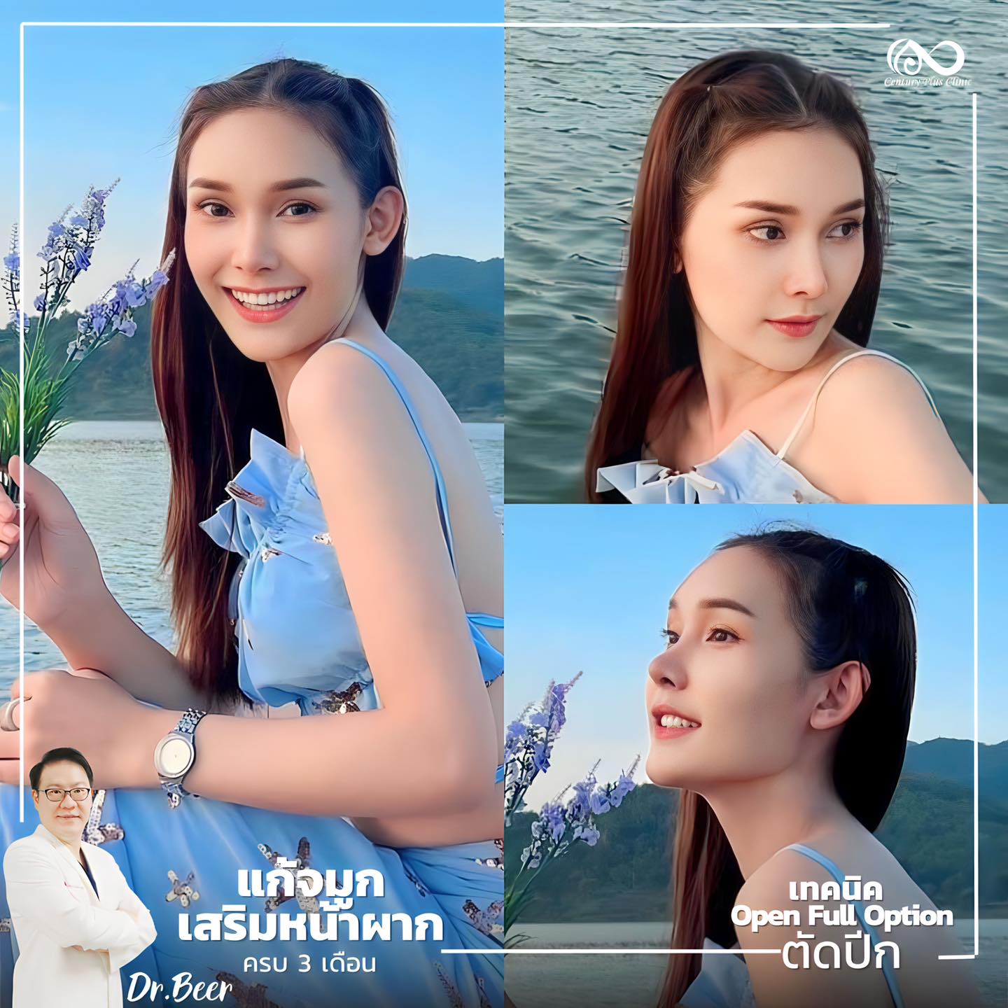 รีวิว แก้จมูก #1032 , Century Clinic Thailand แก้จมูก #1032