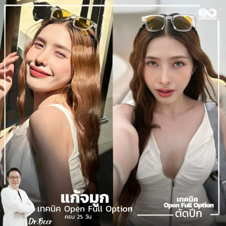 แก้จมูก #1045