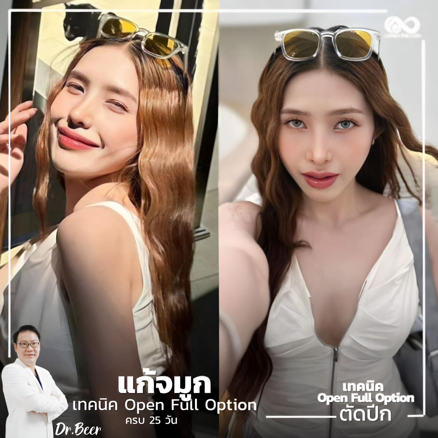 แก้จมูก #1045