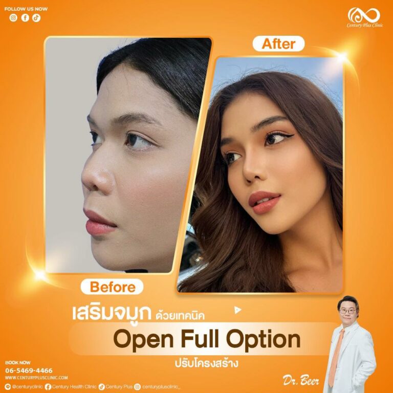เสริมจมูก #1127