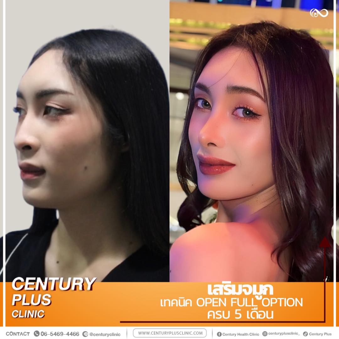 รีวิว เสริมจมูก #1145 , Century Clinic Thailand เสริมจมูก #1145