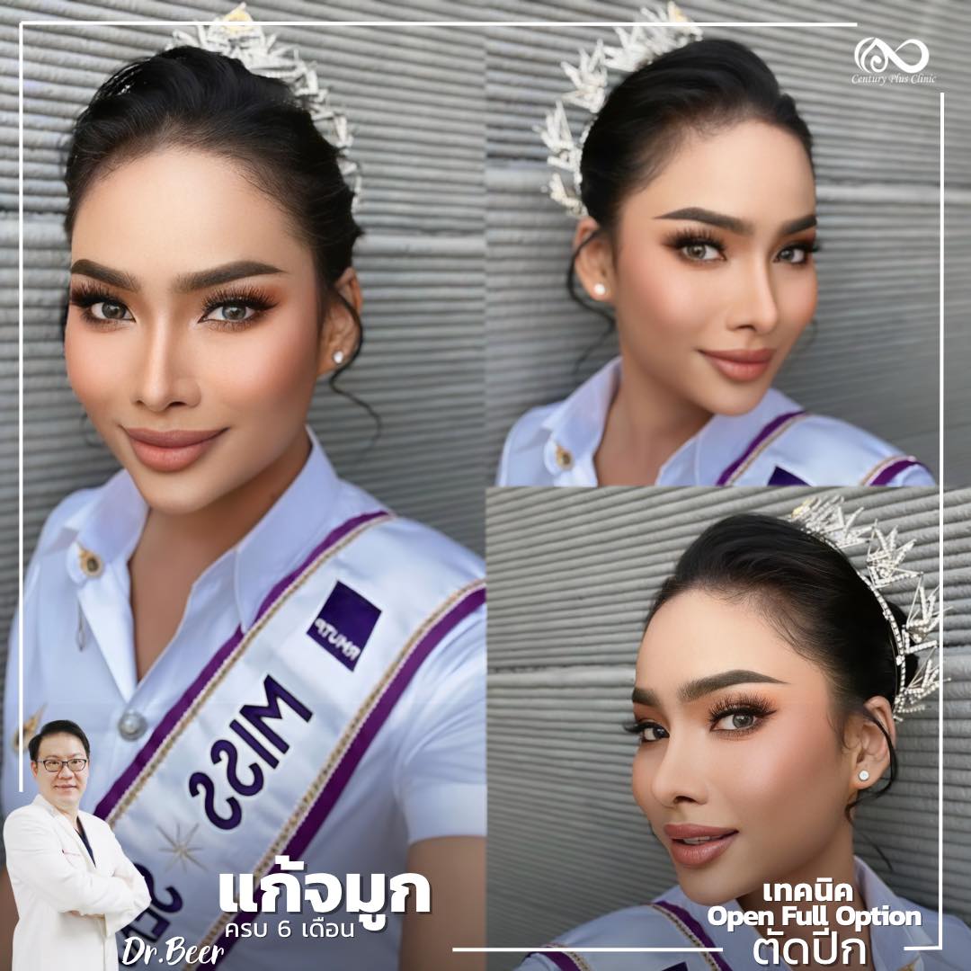 แก้จมูก #1060