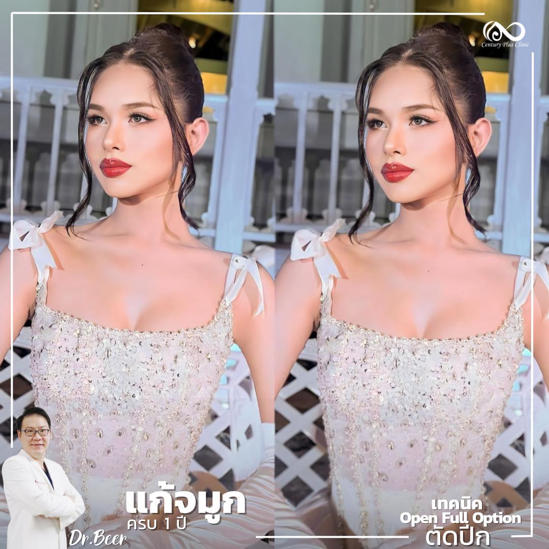 แก้จมูก #1064