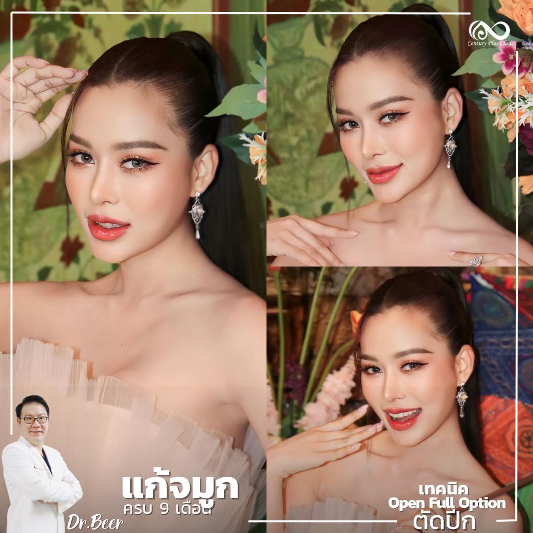รีวิว แก้จมูก #1068 , Century Clinic Thailand แก้จมูก #1068