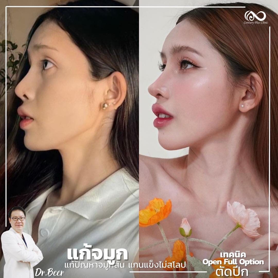 รีวิว แก้จมูก #1072 , Century Clinic Thailand แก้จมูก #1072