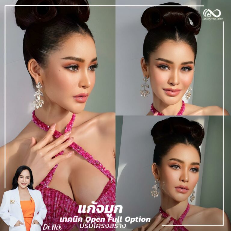 แก้จมูก #1074