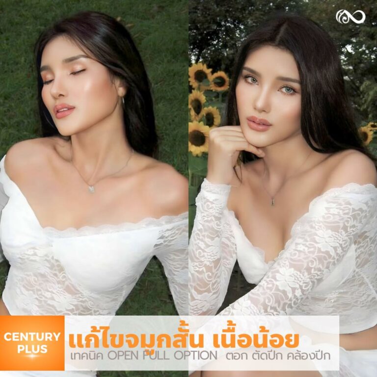 รีวิว แก้จมูก #1108