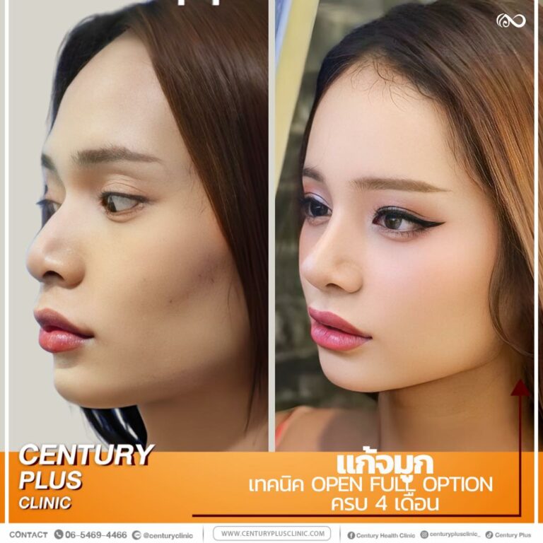 แก้จมูก #1128