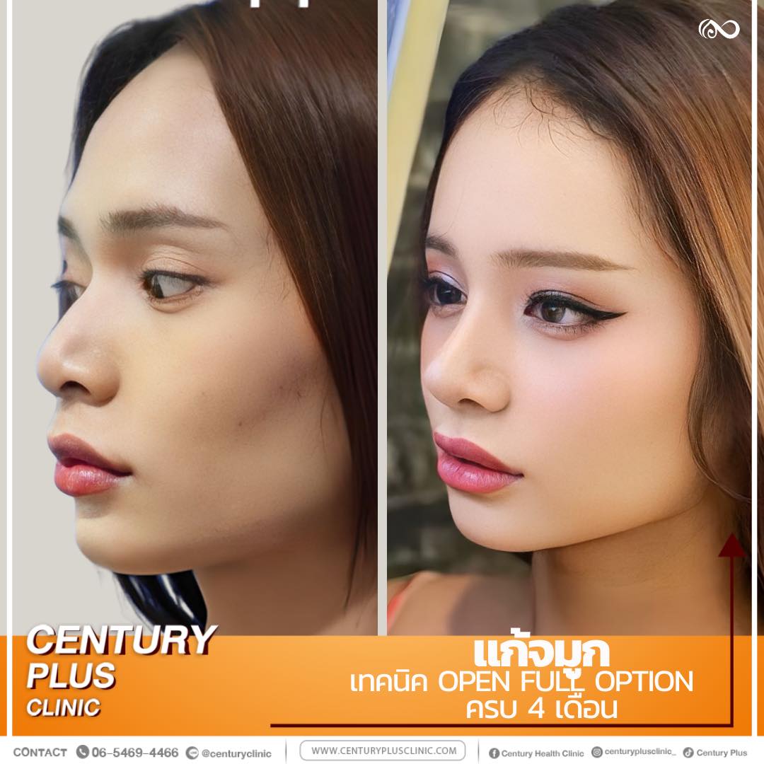 แก้จมูก #1128