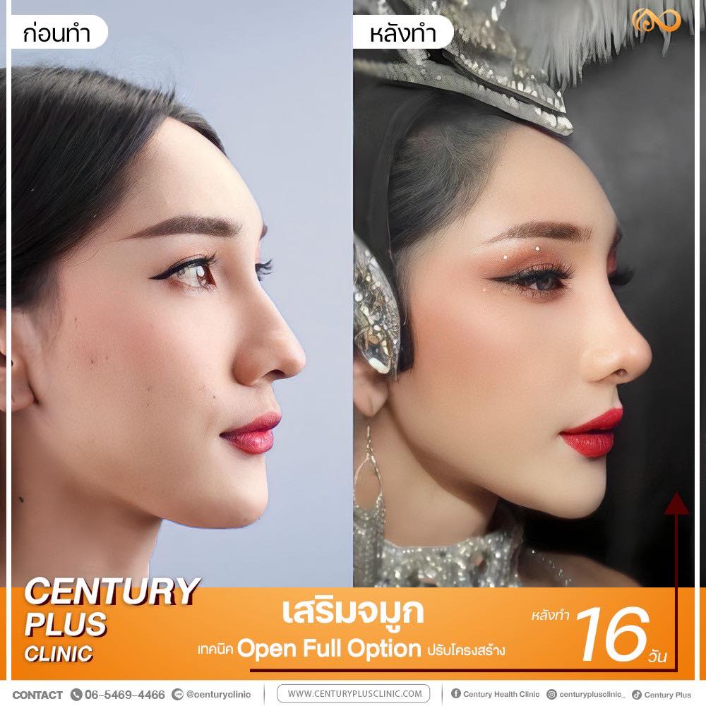 เสริมจมูก #1169