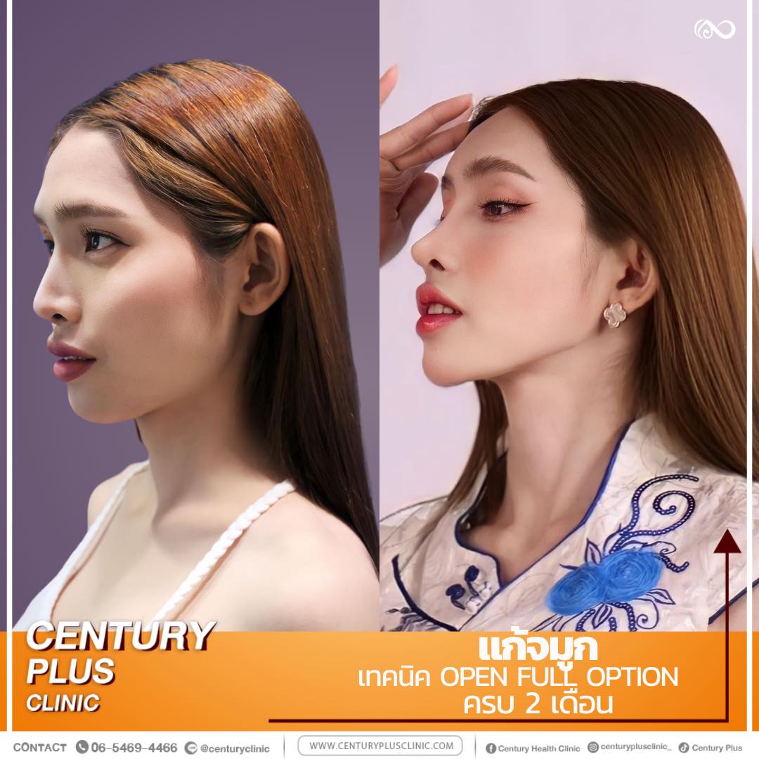 รีวิว แก้จมูก #1155 , Century Clinic Thailand แก้จมูก #1155